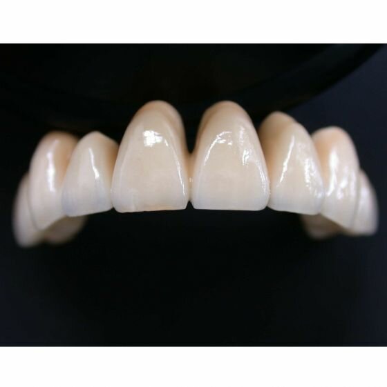Дисгевзия при ношении зубных коронок (фото: www.olgasmile.ru)